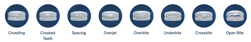 teeth aligners information