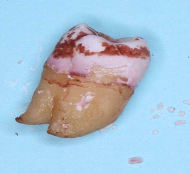 tooth enamel
